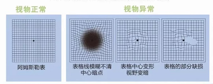 <b>黄斑变性严重危害视力</b>