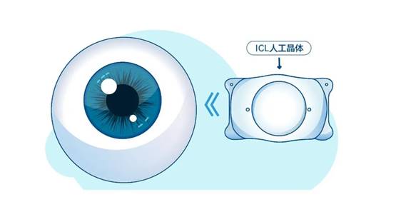 <b>科普|为什么ICL这么贵？</b>