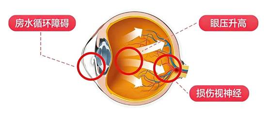 科普 | 冬天晨练容易得青光眼?