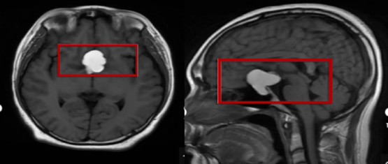 科普 | 视力下降眼科检查却未见异常 专家提醒：警惕脑部病变！