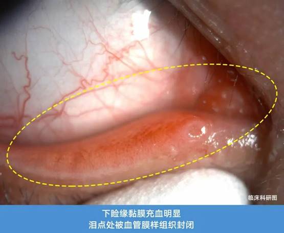 科普 | 总流眼泪？别急着滴眼药水，真正的问题可能在眼睑！
